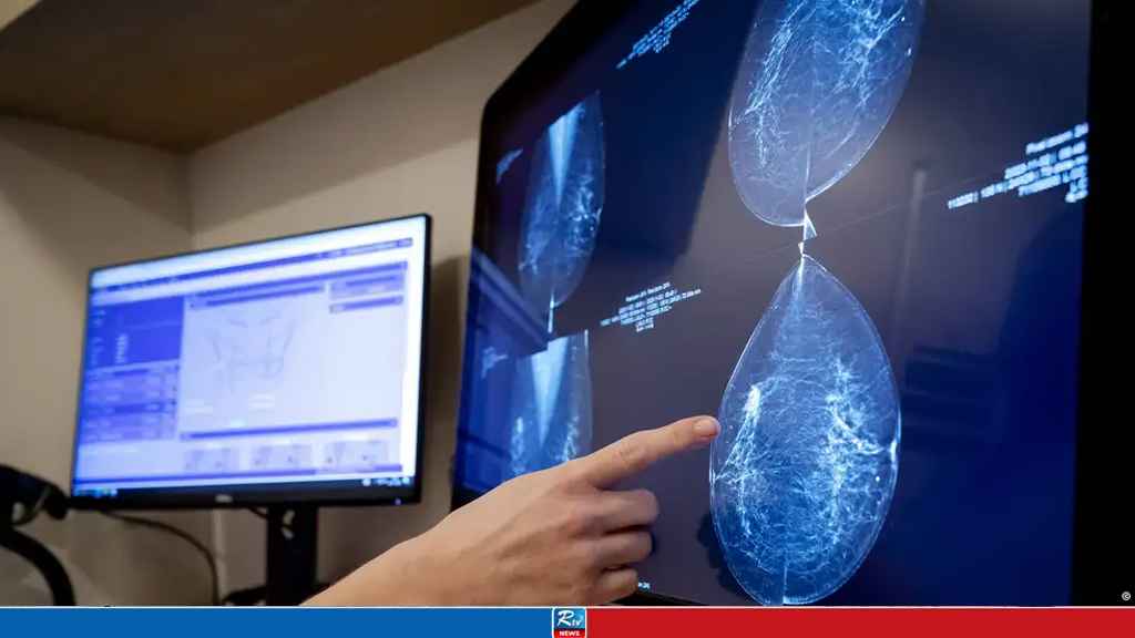 New AI Model Can Predict 5-Year Breast Cancer Risk