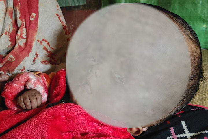 সন্তানের ‘হাইড্রোকাফেলাস’ রোগ, চিকিৎসায় সর্বস্ব বিক্রি করে পালিয়ে বেড়াচ্ছে পরিবার!
